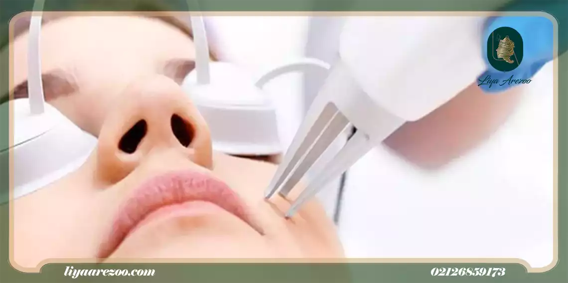 شروع ایمن لیزر موهای زائد بعد از عمل بینی