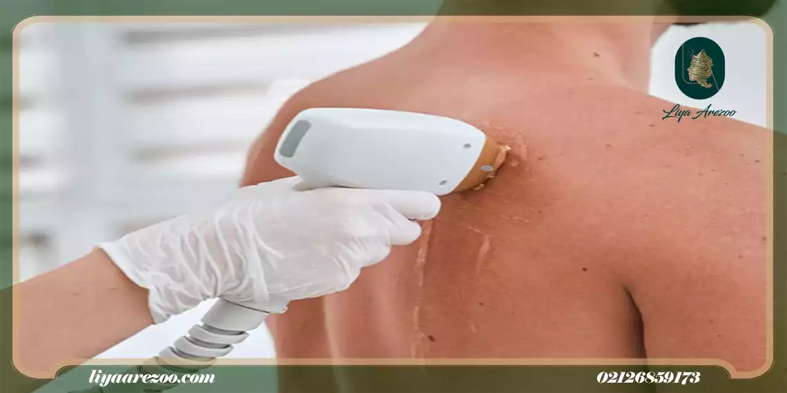 آیا حتما باید با لیزر موهای زائد کمر را از بین ببریم؟
