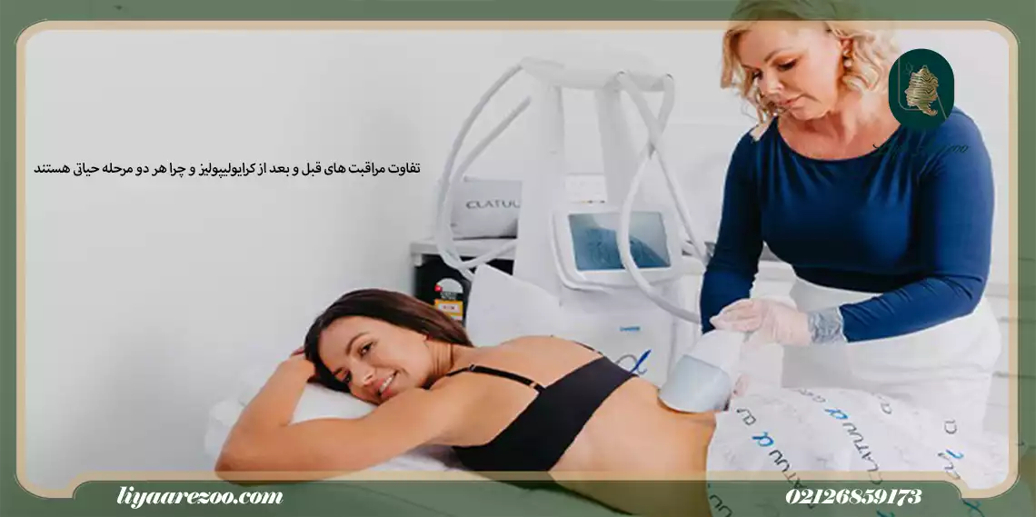 تفاوت مراقبت های قبل و بعد از کرایولیپولیز و چرا هر دو مرحله حیاتی هستند