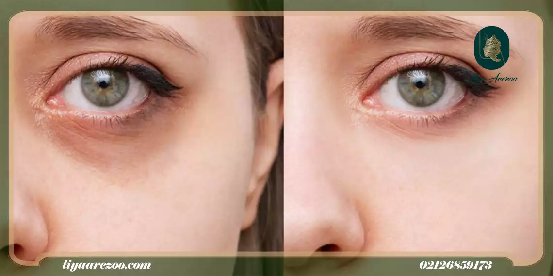 مزایا و معایب مزوتراپی زیر چشم؛ انتخابی طبیعی و تدریجی